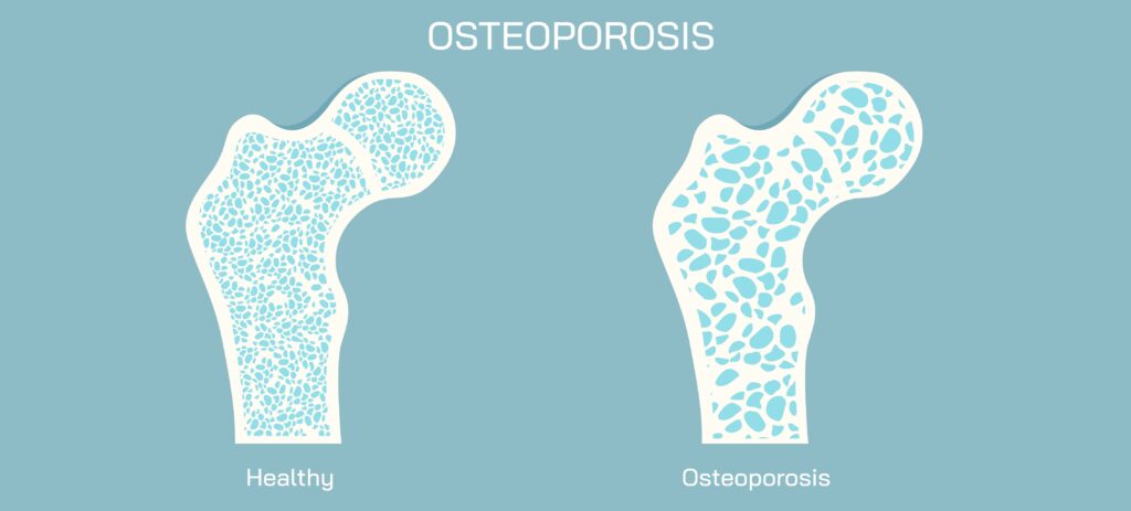 osteoporosis, bone health, osteopenia, bone denisty